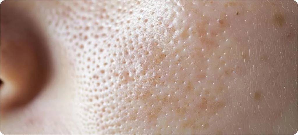Skin Texture & Enlarged Pores